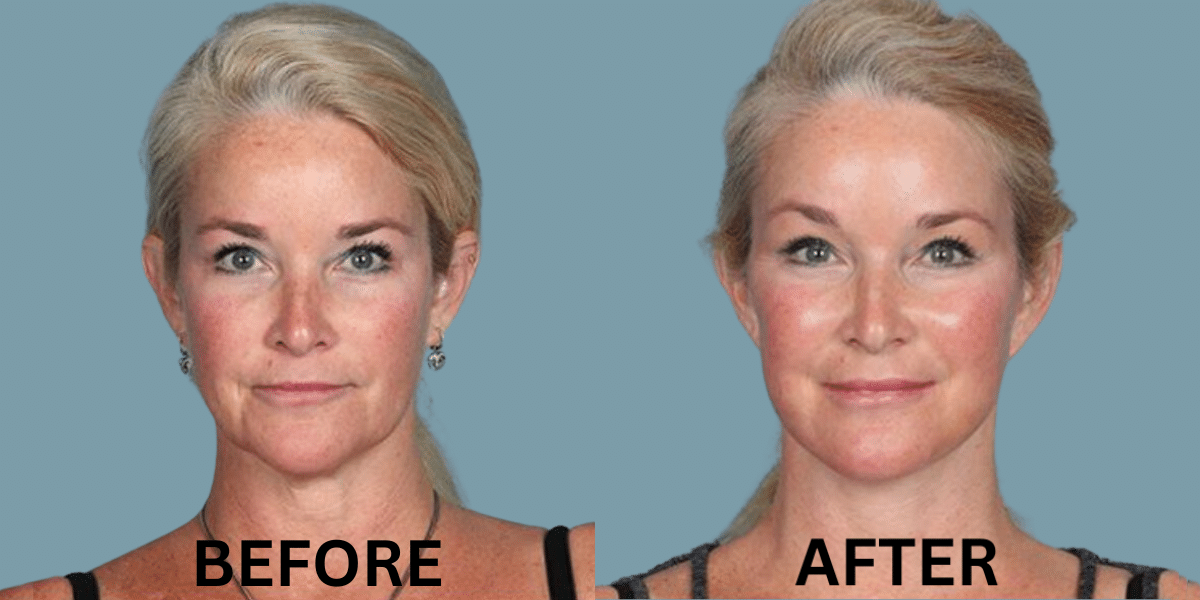 What Does a Facelift Before and After Look Like?