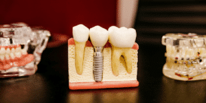 Hidden Health Risks- Dr. Pompa Reveals How Root Canals May Be Making You Sick