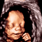 Elective Ultrasounds: Strengthening Parent-Baby Connections