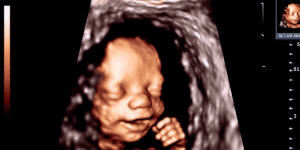 Elective Ultrasounds: Strengthening Parent-Baby Connections