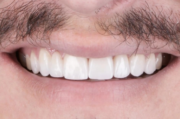 Veneers With Rubber Dam Isolation: Why Champions Dental Takes a Different Approach